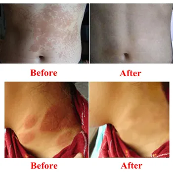 Ifory 5szt Natural Powerful Professional Cure Psoriasis maść skóry, egzema krem zapalenie skóry Экзематоидная egzema leczenie krem