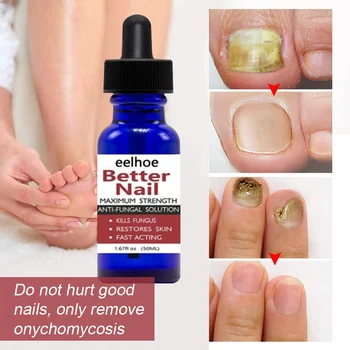 Nail Repair Serum Liquid-Treatment Toe Nail Art Fungus Removal przeciwzakaźne Zanokcica Onychomycosis Essence Nail-Care 50 ml